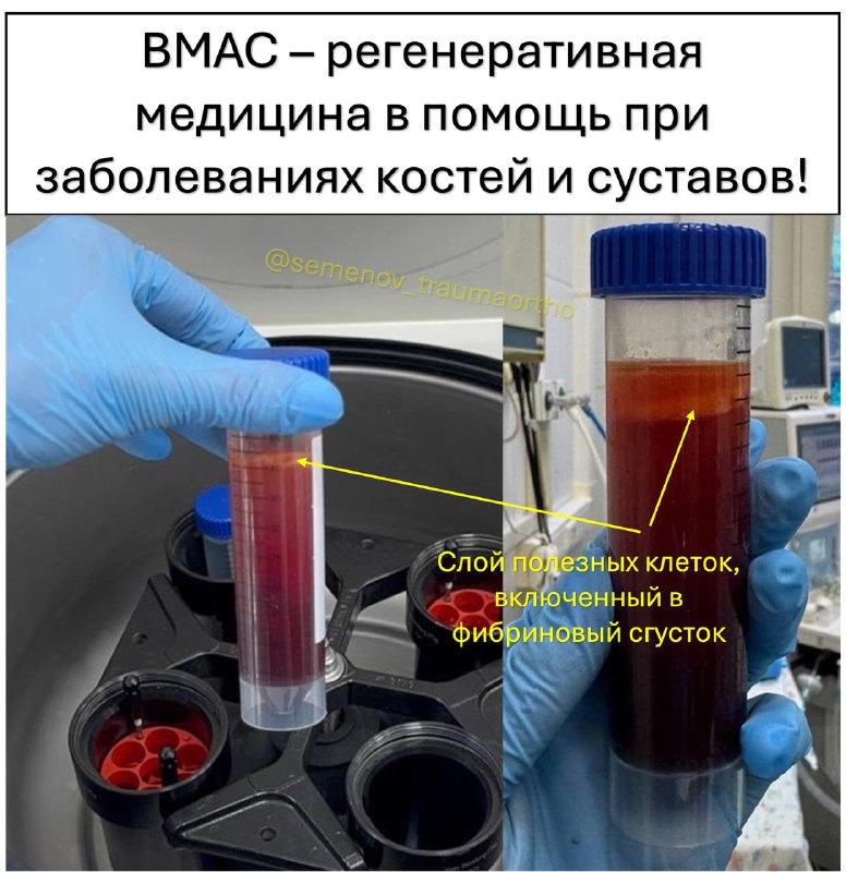 BMAC: инновация в лечении некроза костей — рентгенограмма, разбор клинического случая