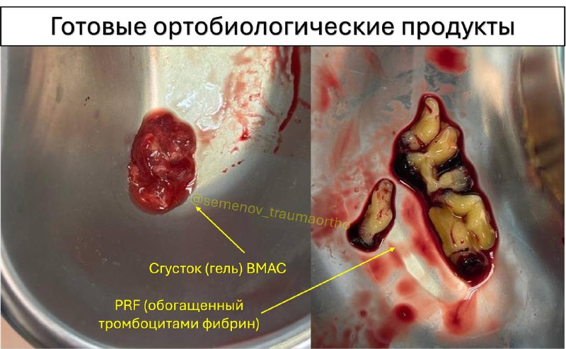 BMAC: инновация в лечении некроза костей — рентгенограмма, разбор клинического случая