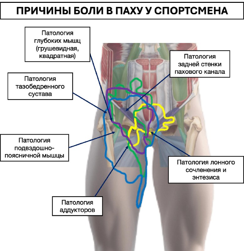 Боль в паху у спортсмена — рентгенограмма, разбор клинического случая