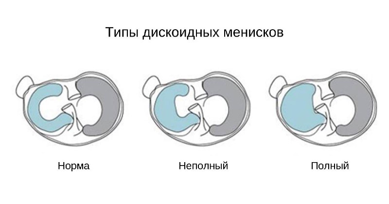 Дискоидный мениск: диагностика и лечение — рентгенограмма, разбор клинического случая