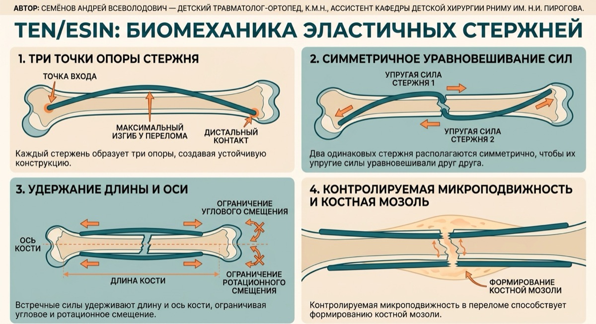 Эластичный остеосинтез у детей: как стержни удерживают перелом — иллюстрация к материалу