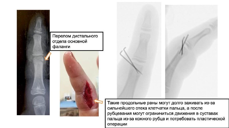 Электросамокат и открытый перелом: риски для детей — рентгенограмма, разбор клинического случая
