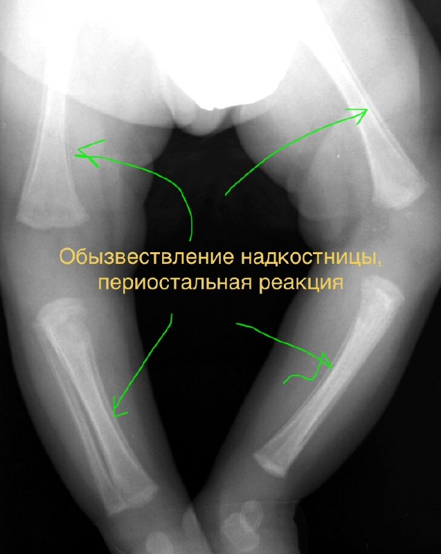 Физиологический периостит грудничка: когда не нужно паниковать — рентгенограмма, разбор клинического случая