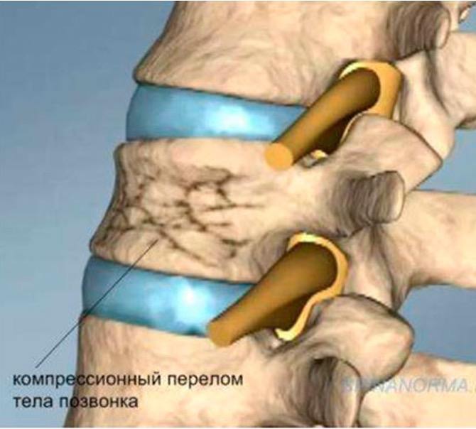 Компрессионные переломы позвоночника у детей — рентгенограмма, разбор клинического случая