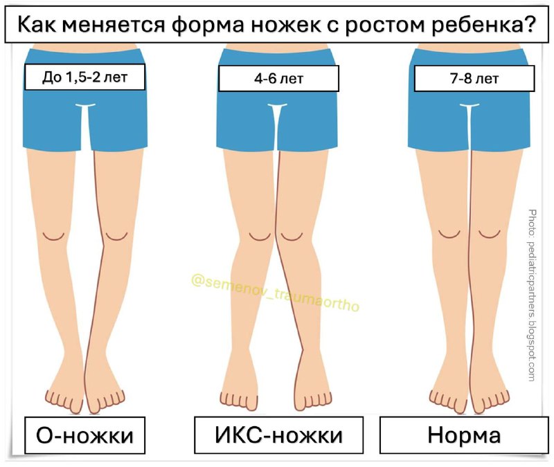 О-ножки и Х-ножки: Норма или патология?