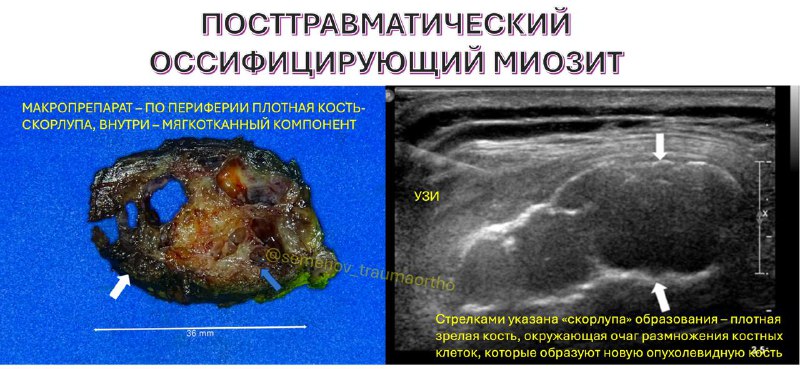 Оссифицирующий миозит — рентгенограмма, разбор клинического случая