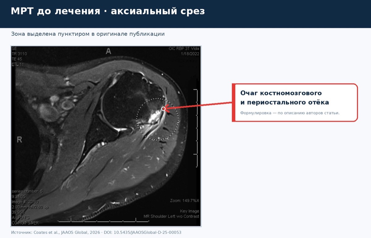 Остеомиелит плеча после прививки: разбор случая из литературы — иллюстрация к материалу