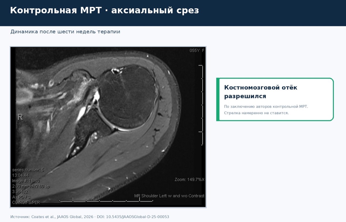 Остеомиелит плеча после прививки: разбор случая из литературы — иллюстрация к материалу