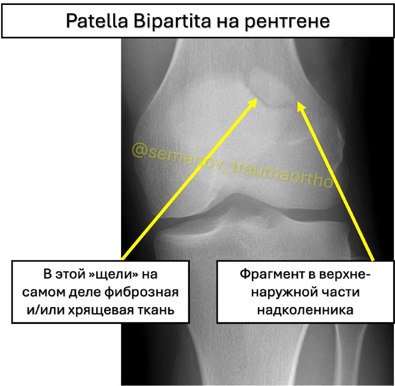 Patella Bipartita (двудольный надколенник) — рентгенограмма, разбор клинического случая