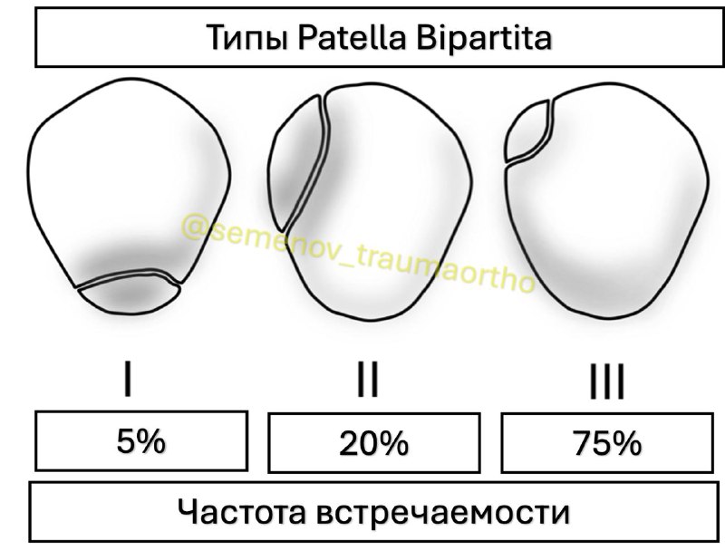 Patella Bipartita (двудольный надколенник) — рентгенограмма, разбор клинического случая