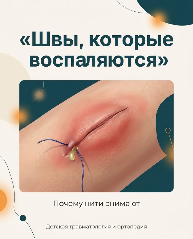 Почему я снимаю швы, а не жду, когда они рассосутся — рентгенограмма, разбор клинического случая