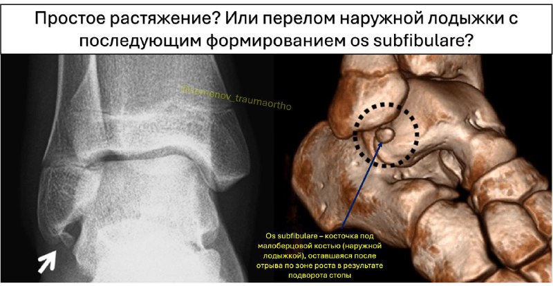 Подворот стопы или перелом лодыжки? — рентгенограмма, разбор клинического случая