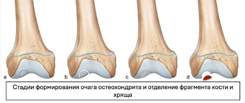 Рассекающий остеохондрит (болезнь Кенига) — рентгенограмма, разбор клинического случая