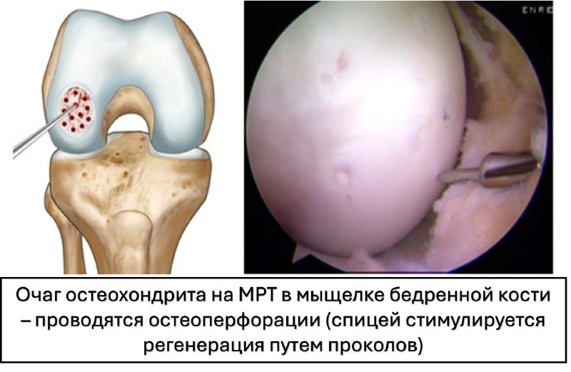 Рассекающий остеохондрит (болезнь Кенига) — рентгенограмма, разбор клинического случая