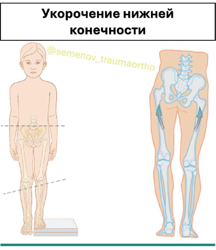 Разная длина ног! — рентгенограмма, разбор клинического случая