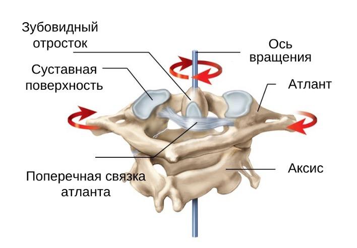 Ротационный подвывих С1 позвонка