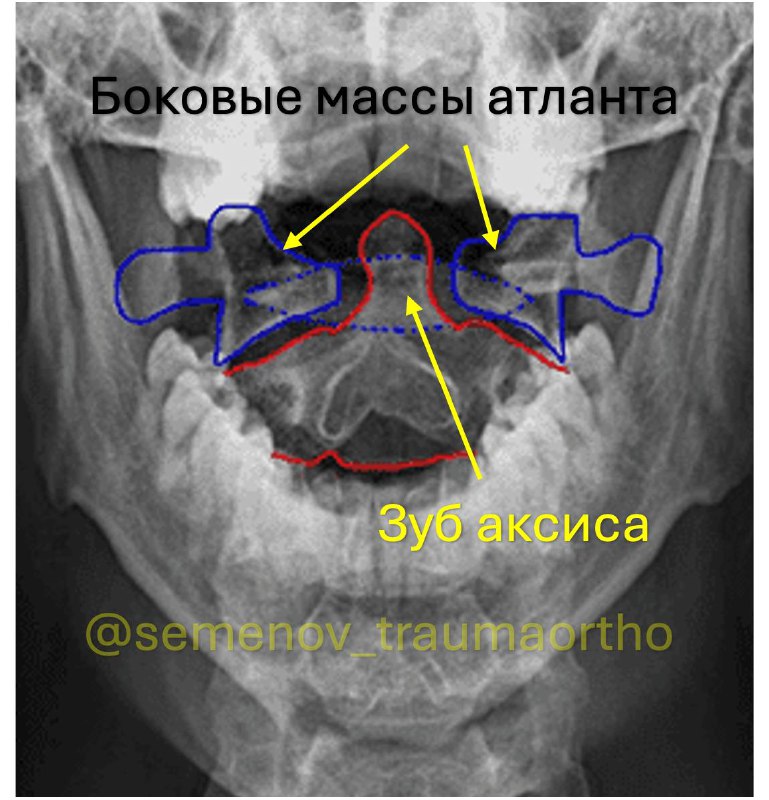 Ротационный подвывих С1 позвонка — рентгенограмма, разбор клинического случая