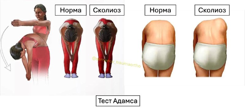Сколиоз или кривая спинка: как отличить?