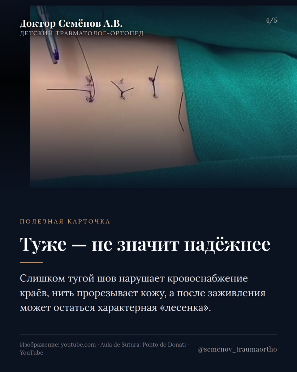 Внутрикожный шов у детей: безопасно ли это? — иллюстрация к материалу
