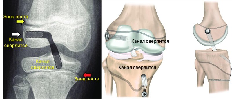 Восстановление ПКС у детей: методы без повреждения зон роста — рентгенограмма, разбор клинического случая