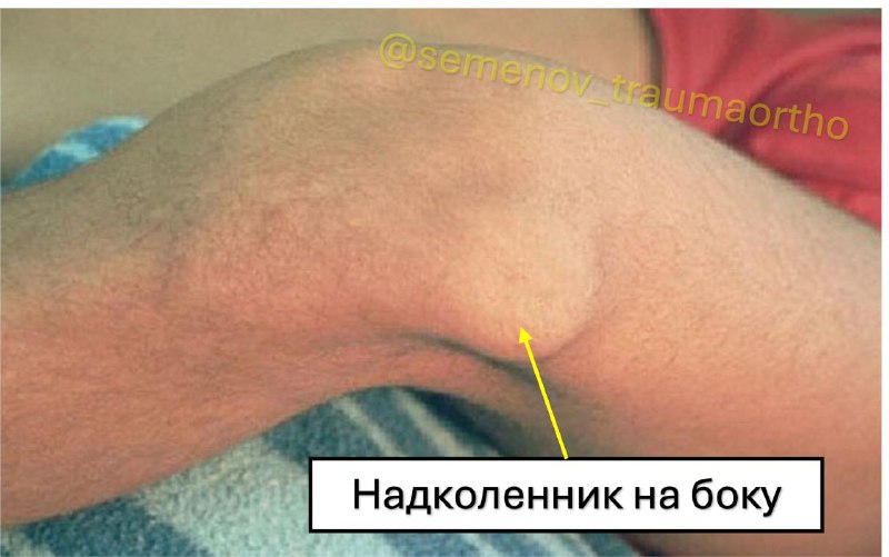 Вывих надколенника — рентгенограмма, разбор клинического случая