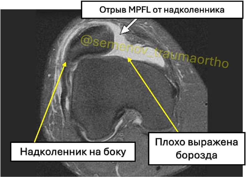 Вывих надколенника — рентгенограмма, разбор клинического случая