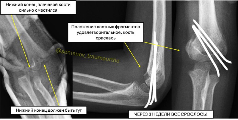 Чрезмыщелковый перелом плеча у ребенка после падения с качелей
