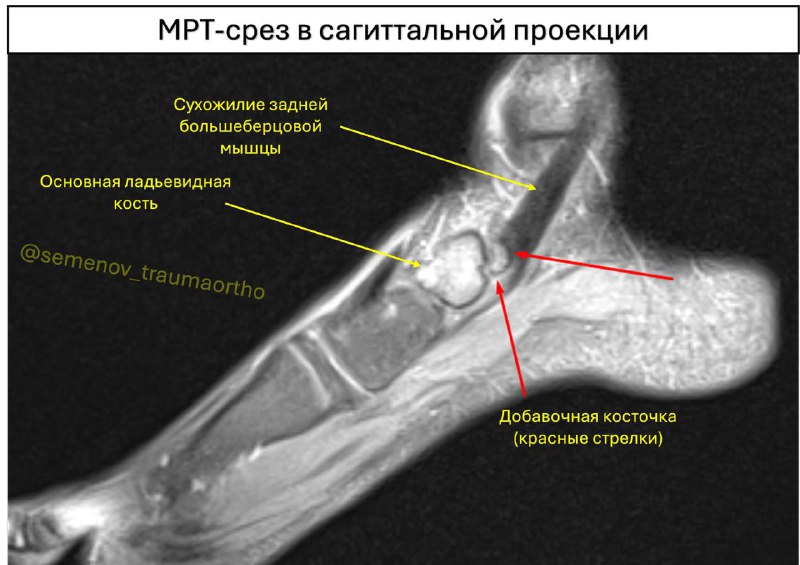 Добавочная ладьевидная кость у спортсменов