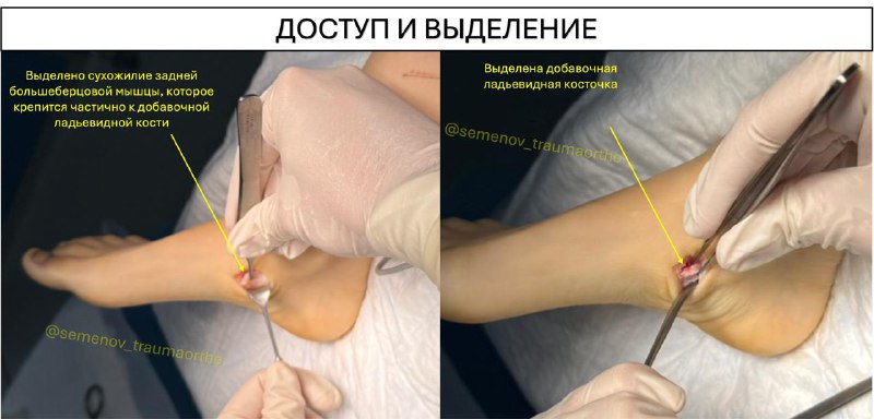 Добавочная ладьевидная кость у спортсменов — рентгенограмма, разбор клинического случая