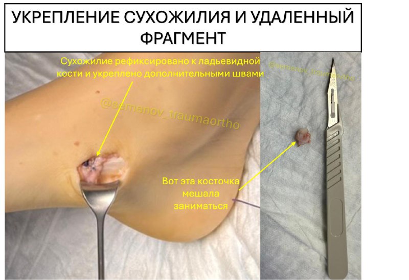 Добавочная ладьевидная кость у спортсменов — рентгенограмма, разбор клинического случая