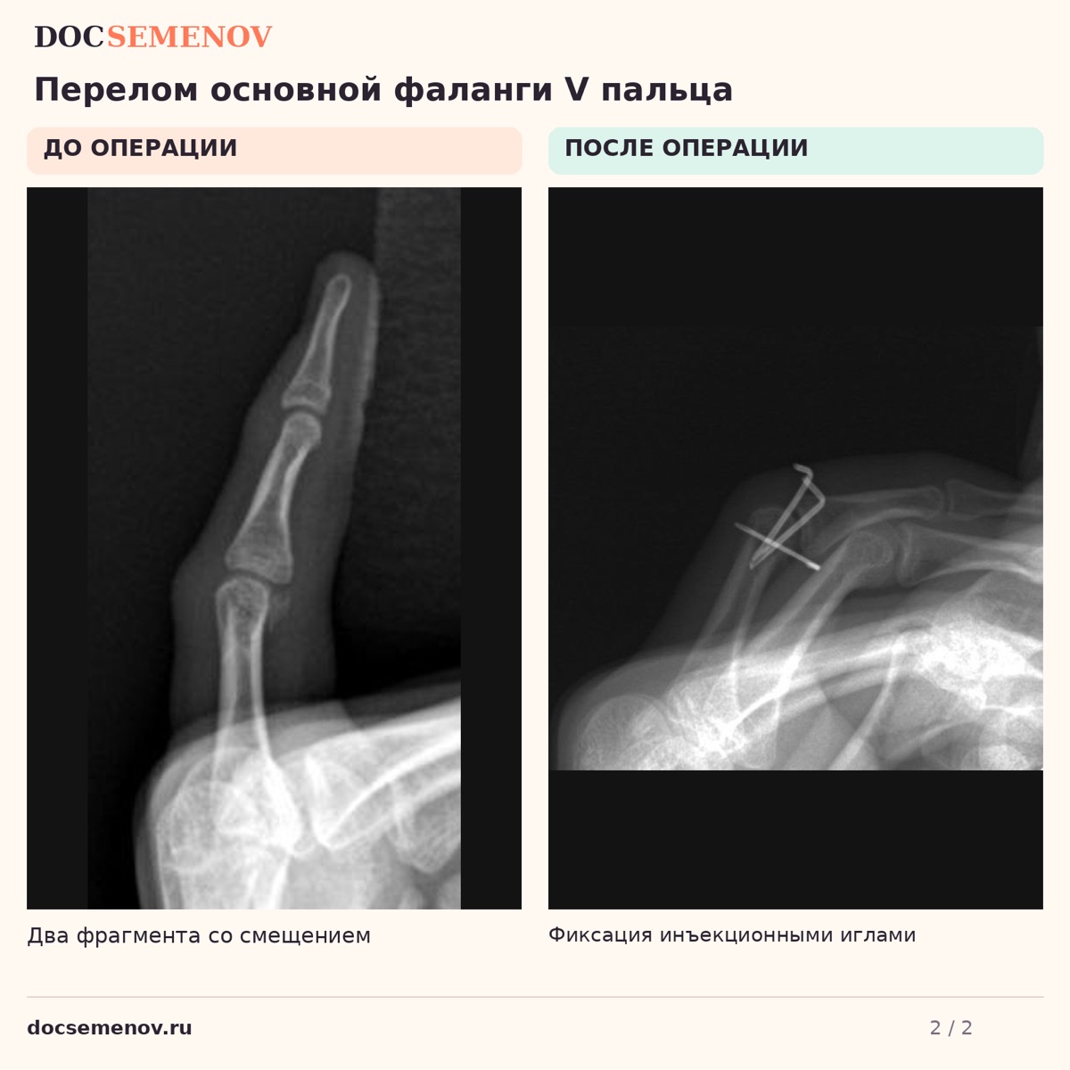 Оскольчатый перелом фаланги мизинца у ребёнка — изображение к разбору клинического случая