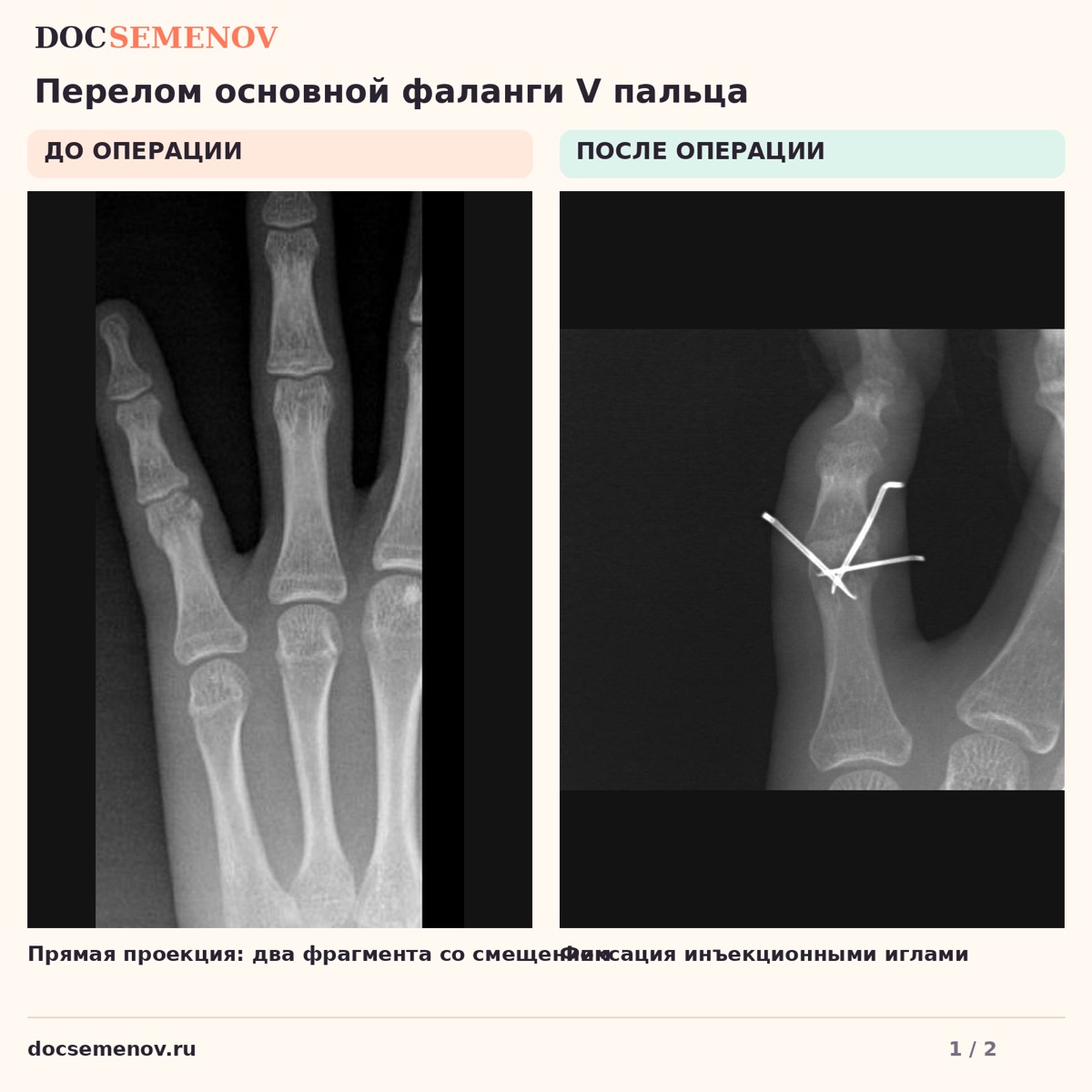 Оскольчатый перелом фаланги мизинца у ребёнка — изображение к разбору клинического случая