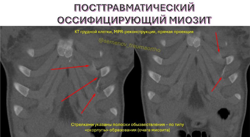 Оссифицирующий миозит у балерины: диагноз без травмы — клинический случай