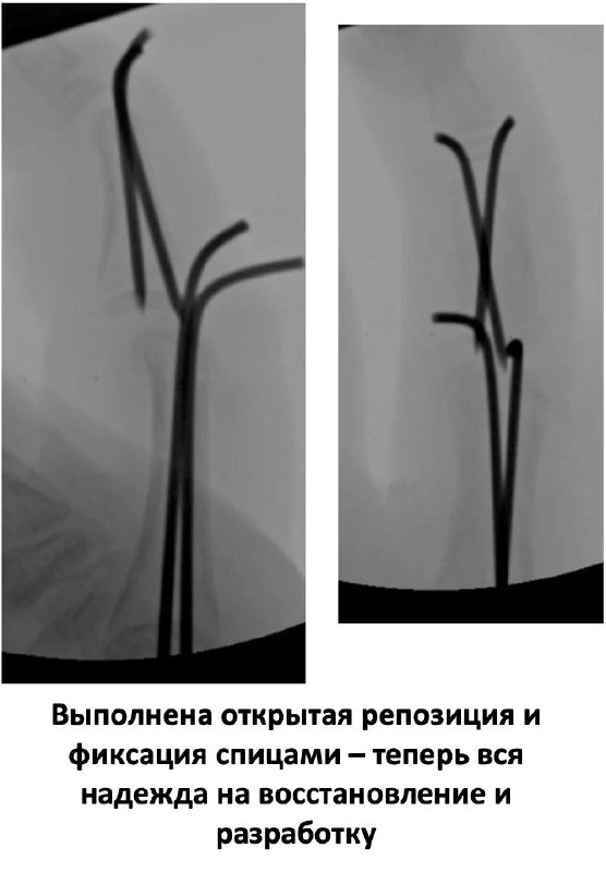 Открытый перелом пальца у ребенка — рентгенограмма, разбор клинического случая