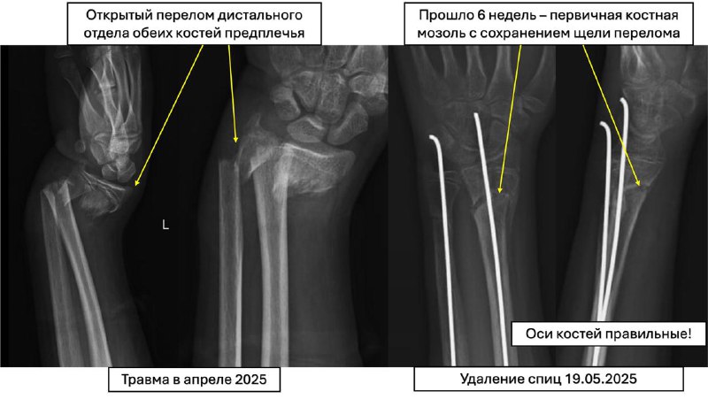 Открытый перелом предплечья у подростка: случай из практики