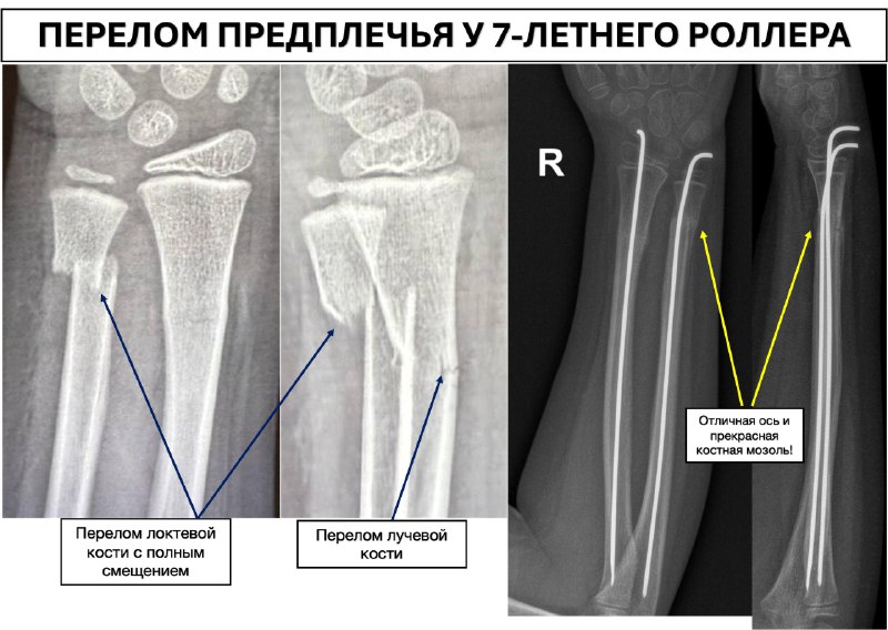 Перелом лучевой и локтевой у 7 летнего
