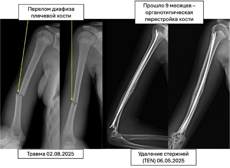Перелом плечевой кости - TEN — клинический случай