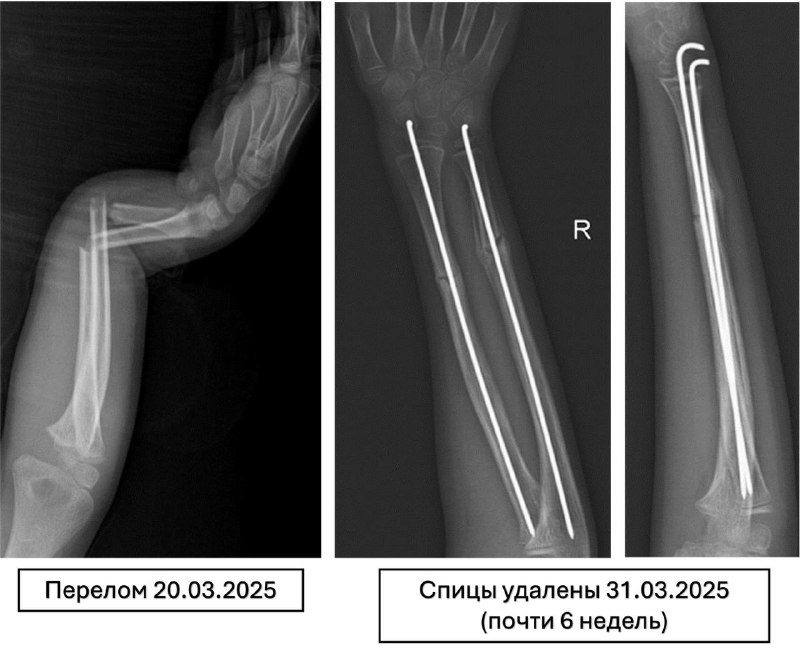 Перелом предплечья у ребенка с угловым смещением