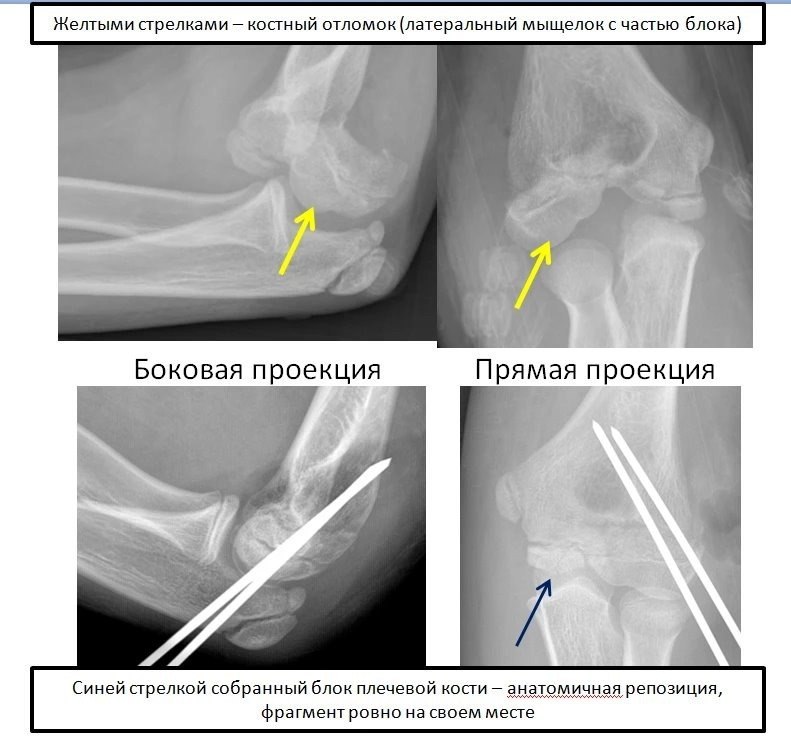 Редкий перелом локтя у ребенка: случай из практики — рентгенограмма, разбор клинического случая