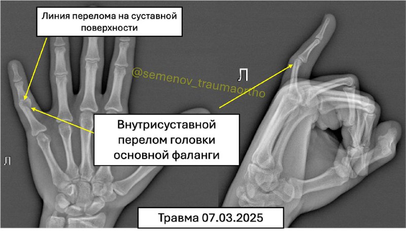 Внутрисуставной перелом фаланги пальца