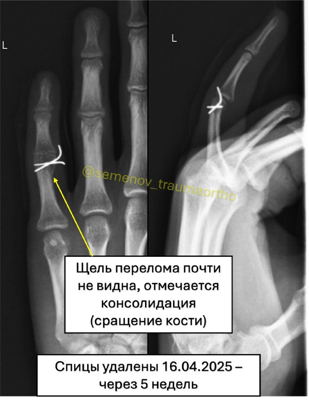 Внутрисуставной перелом фаланги пальца — рентгенограмма, разбор клинического случая